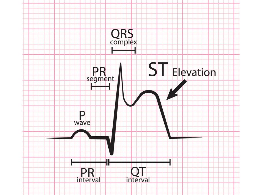 ST elevation Myocardial Infarction comprises of approximately  60% of acute coronary syndrome in India